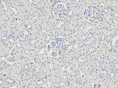 DDX5 Antibody - Immunohistochemistry of paraffin-embedded human thyroid cancer using DDX5 antibody at dilution of 1:200 (200x lens).