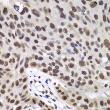 DDX5 Antibody - Immunohistochemistry of paraffin-embedded human lung cancer tissue.
