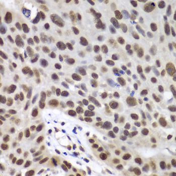 DDX5 Antibody - Immunohistochemistry of paraffin-embedded human lung cancer using DDX5 antibody at dilution of 1:100 (40x lens).