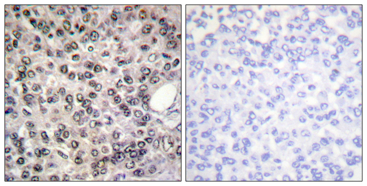DDX5 Antibody - Immunohistochemistry analysis of paraffin-embedded human breast carcinoma, using DDX5/DEAD-box Protein 5 (Phospho-Tyr593) Antibody. The picture on the right is blocked with the phospho peptide.