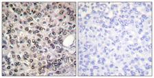 DDX5 Antibody - Immunohistochemistry analysis of paraffin-embedded human breast carcinoma, using DDX5/DEAD-box Protein 5 (Phospho-Tyr593) Antibody. The picture on the right is blocked with the phospho peptide.