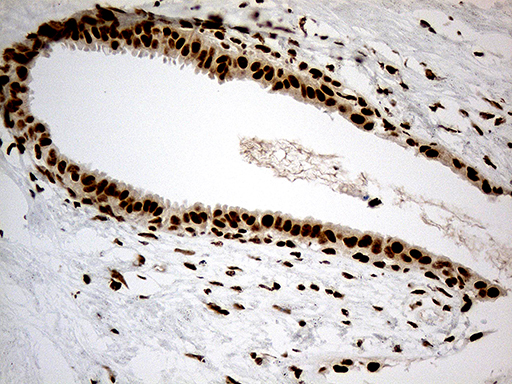 DDX50 Antibody - Immunohistochemical staining of paraffin-embedded Human breast tissue within the normal limits using anti-DDX50 mouse monoclonal antibody. (Heat-induced epitope retrieval by 1mM EDTA in 10mM Tris buffer. (pH8.5) at 120°C for 3 min. (1:1000)