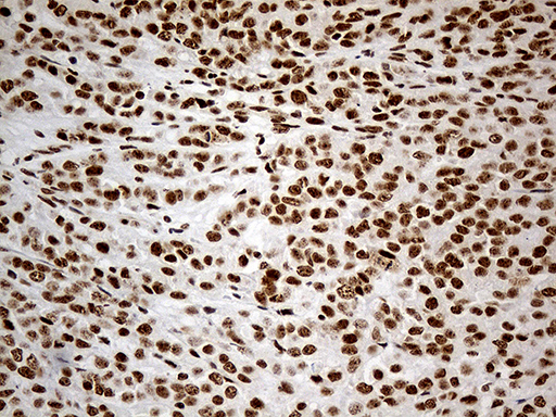 DDX50 Antibody - Immunohistochemical staining of paraffin-embedded Adenocarcinoma of Human breast tissue tissue using anti-DDX50 mouse monoclonal antibody. (Heat-induced epitope retrieval by 1mM EDTA in 10mM Tris buffer. (pH8.5) at 120°C for 3 min. (1:1000)