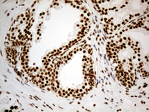DDX50 Antibody - Immunohistochemical staining of paraffin-embedded Carcinoma of Human prostate tissue using anti-DDX50 mouse monoclonal antibody. (Heat-induced epitope retrieval by 1mM EDTA in 10mM Tris buffer. (pH8.5) at 120°C for 3 min. (1:1000)
