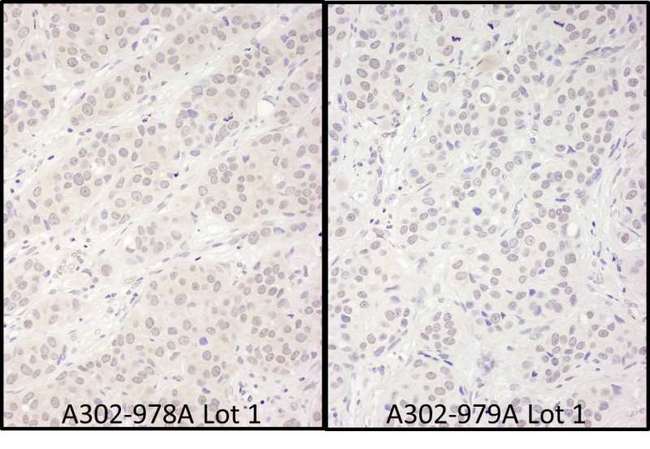DDX56 Antibody - Detection of Human DDX56 by Immunohistochemistry. Samples: FFPE serial sections of human breast carcinoma. Antibody: Affinity purified rabbit anti-DDX56 used at a dilution of 1:1000 (1 ug/ml). Detection: DAB.