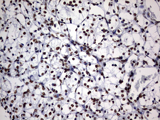 DDX56 Antibody - IHC of paraffin-embedded Carcinoma of Human kidney tissue using anti-DDX56 mouse monoclonal antibody. (Heat-induced epitope retrieval by 10mM citric buffer, pH6.0, 120°C for 3min).