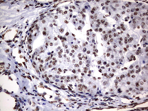 DDX56 Antibody - IHC of paraffin-embedded Carcinoma of Human liver tissue using anti-DDX56 mouse monoclonal antibody. (Heat-induced epitope retrieval by 10mM citric buffer, pH6.0, 120°C for 3min).