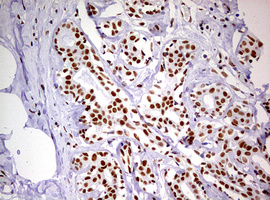 DDX56 Antibody - IHC of paraffin-embedded Human breast tissue using anti-DDX56 mouse monoclonal antibody. (Heat-induced epitope retrieval by 10mM citric buffer, pH6.0, 120°C for 3min).
