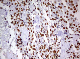 DDX56 Antibody - IHC of paraffin-embedded Adenocarcinoma of Human breast tissue using anti-DDX56 mouse monoclonal antibody. (Heat-induced epitope retrieval by 10mM citric buffer, pH6.0, 120°C for 3min).