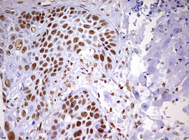 DDX56 Antibody - IHC of paraffin-embedded Carcinoma of Human lung tissue using anti-DDX56 mouse monoclonal antibody. (Heat-induced epitope retrieval by 10mM citric buffer, pH6.0, 120°C for 3min).