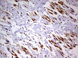 DDX56 Antibody - IHC of paraffin-embedded Adenocarcinoma of Human ovary tissue using anti-DDX56 mouse monoclonal antibody. (Heat-induced epitope retrieval by 10mM citric buffer, pH6.0, 120°C for 3min).