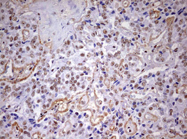 DDX56 Antibody - IHC of paraffin-embedded Carcinoma of Human pancreas tissue using anti-DDX56 mouse monoclonal antibody. (Heat-induced epitope retrieval by 10mM citric buffer, pH6.0, 120°C for 3min).