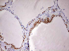 DDX56 Antibody - IHC of paraffin-embedded Human thyroid tissue using anti-DDX56 mouse monoclonal antibody. (Heat-induced epitope retrieval by 10mM citric buffer, pH6.0, 120°C for 3min).