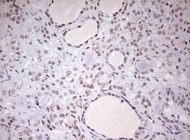 DDX56 Antibody - IHC of paraffin-embedded Carcinoma of Human thyroid tissue using anti-DDX56 mouse monoclonal antibody. (Heat-induced epitope retrieval by 10mM citric buffer, pH6.0, 120°C for 3min).
