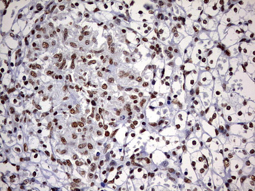 DDX56 Antibody - IHC of paraffin-embedded Carcinoma of Human kidney tissue using anti-DDX56 mouse monoclonal antibody. (Heat-induced epitope retrieval by 10mM citric buffer, pH6.0, 120°C for 3min).