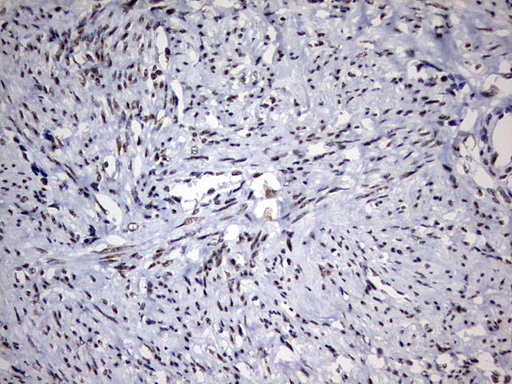 DDX56 Antibody - IHC of paraffin-embedded Adenocarcinoma of Human endometrium tissue using anti-DDX56 mouse monoclonal antibody. (Heat-induced epitope retrieval by 10mM citric buffer, pH6.0, 120°C for 3min).