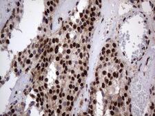 DDX56 Antibody - Immunohistochemical staining of paraffin-embedded Adenocarcinoma of Human breast tissue using anti-DDX56 mouse monoclonal antibody.  heat-induced epitope retrieval by 1 mM EDTA in 10mM Tris, pH9.0, 120C for 3min)
