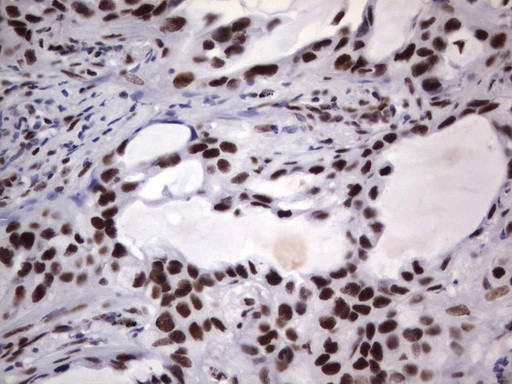 DDX56 Antibody - Immunohistochemical staining of paraffin-embedded Carcinoma of Human lung tissue using anti-DDX56 mouse monoclonal antibody.  heat-induced epitope retrieval by 1 mM EDTA in 10mM Tris, pH9.0, 120C for 3min)