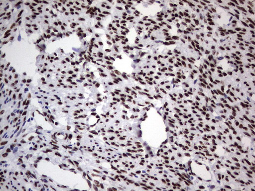 DDX56 Antibody - Immunohistochemical staining of paraffin-embedded Human endometrium tissue using anti-DDX56 mouse monoclonal antibody.  heat-induced epitope retrieval by 1 mM EDTA in 10mM Tris, pH9.0, 120C for 3min)