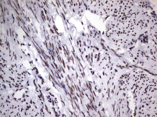 DDX56 Antibody - Immunohistochemical staining of paraffin-embedded Adenocarcinoma of Human endometrium tissue using anti-DDX56 mouse monoclonal antibody.  heat-induced epitope retrieval by 1 mM EDTA in 10mM Tris, pH9.0, 120C for 3min)