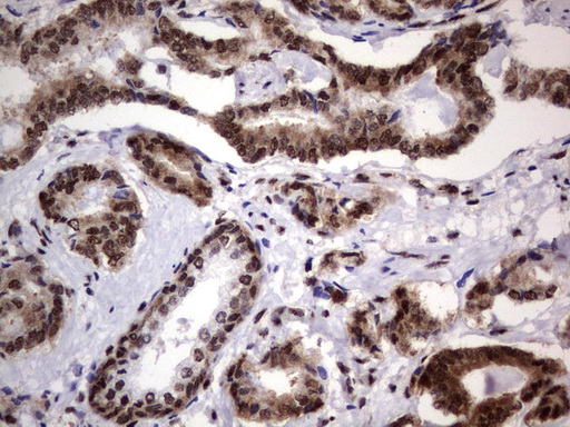 DDX56 Antibody - Immunohistochemical staining of paraffin-embedded Human prostate tissue using anti-DDX56 mouse monoclonal antibody.  heat-induced epitope retrieval by 1 mM EDTA in 10mM Tris, pH9.0, 120C for 3min)