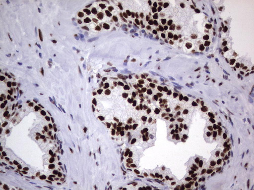 DDX56 Antibody - Immunohistochemical staining of paraffin-embedded Carcinoma of Human prostate tissue using anti-DDX56 mouse monoclonal antibody.  heat-induced epitope retrieval by 1 mM EDTA in 10mM Tris, pH9.0, 120C for 3min)