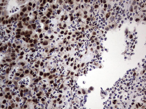 DDX56 Antibody - Immunohistochemical staining of paraffin-embedded Human lymph node tissue using anti-DDX56 mouse monoclonal antibody.  heat-induced epitope retrieval by 1 mM EDTA in 10mM Tris, pH9.0, 120C for 3min)