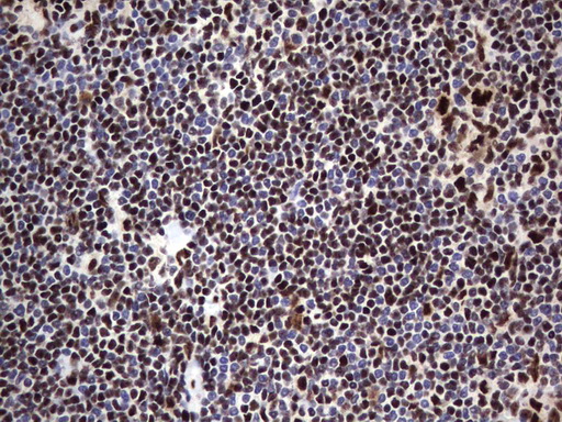 DDX56 Antibody - Immunohistochemical staining of paraffin-embedded Human lymphoma tissue using anti-DDX56 mouse monoclonal antibody.  heat-induced epitope retrieval by 1 mM EDTA in 10mM Tris, pH9.0, 120C for 3min)