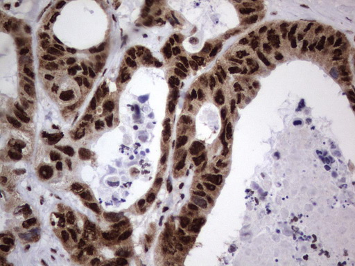 DDX56 Antibody - Immunohistochemical staining of paraffin-embedded Adenocarcinoma of Human colon tissue using anti-DDX56 mouse monoclonal antibody.  heat-induced epitope retrieval by 1 mM EDTA in 10mM Tris, pH9.0, 120C for 3min)