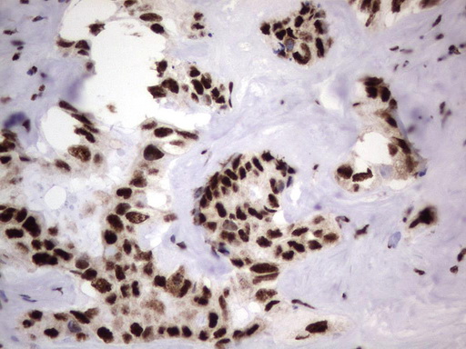 DDX56 Antibody - Immunohistochemical staining of paraffin-embedded Carcinoma of Human liver tissue using anti-DDX56 mouse monoclonal antibody.  heat-induced epitope retrieval by 1 mM EDTA in 10mM Tris, pH9.0, 120C for 3min)