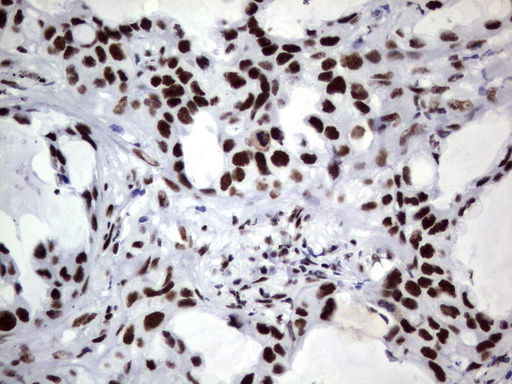 DDX56 Antibody - Immunohistochemical staining of paraffin-embedded Carcinoma of Human lung tissue using anti-DDX56mouse monoclonal antibody.  heat-induced epitope retrieval by 1 mM EDTA in 10mM Tris, pH9.0, 120C for 3min)