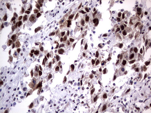 DDX56 Antibody - Immunohistochemical staining of paraffin-embedded Adenocarcinoma of Human ovary tissue using anti-DDX56 mouse monoclonal antibody.  heat-induced epitope retrieval by 1 mM EDTA in 10mM Tris, pH9.0, 120C for 3min)