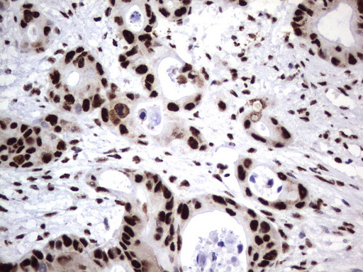 DDX56 Antibody - Immunohistochemical staining of paraffin-embedded Carcinoma of Human pancreas tissue using anti-DDX56 mouse monoclonal antibody.  heat-induced epitope retrieval by 1 mM EDTA in 10mM Tris, pH9.0, 120C for 3min)