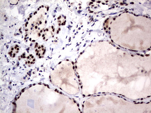 DDX56 Antibody - Immunohistochemical staining of paraffin-embedded Human thyroid tissue using anti-DDX56 mouse monoclonal antibody.  heat-induced epitope retrieval by 1 mM EDTA in 10mM Tris, pH9.0, 120C for 3min)