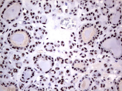 DDX56 Antibody - Immunohistochemical staining of paraffin-embedded Carcinoma of Human thyroid tissue using anti-DDX56 mouse monoclonal antibody.  heat-induced epitope retrieval by 1 mM EDTA in 10mM Tris, pH9.0, 120C for 3min)