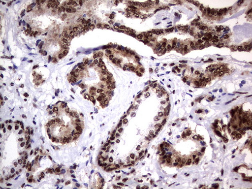 DDX56 Antibody - Immunohistochemical staining of paraffin-embedded Human prostate tissue using anti-DDX56 mouse monoclonal antibody.  heat-induced epitope retrieval by 1 mM EDTA in 10mM Tris, pH9.0, 120C for 3min)