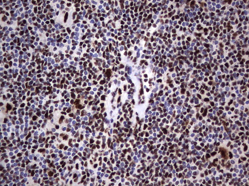 DDX56 Antibody - Immunohistochemical staining of paraffin-embedded Human lymphoma tissue using anti-DDX56 mouse monoclonal antibody.  heat-induced epitope retrieval by 1 mM EDTA in 10mM Tris, pH9.0, 120C for 3min)