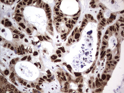 DDX56 Antibody - Immunohistochemical staining of paraffin-embedded Adenocarcinoma of Human colon tissue using anti-DDX56 mouse monoclonal antibody.  heat-induced epitope retrieval by 1 mM EDTA in 10mM Tris, pH9.0, 120C for 3min)