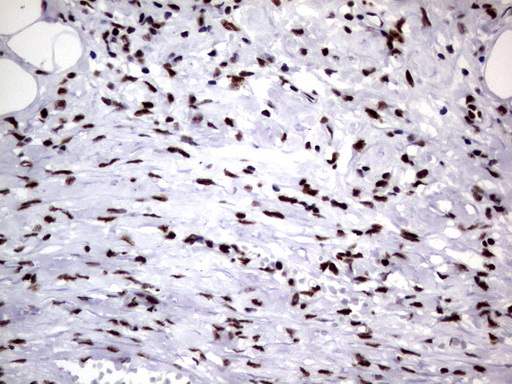 DDX56 Antibody - Immunohistochemical staining of paraffin-embedded Carcinoma of Human kidney tissue using anti-DDX56 mouse monoclonal antibody.  heat-induced epitope retrieval by 1 mM EDTA in 10mM Tris, pH9.0, 120C for 3min)