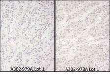 DDX56 Antibody - Detection of Human DDX56 by Immunohistochemistry. Samples: FFPE serial sections of human breast carcinoma. Antibody: Affinity purified rabbit anti-DDX56 used at a dilution of 1:1000 (1 ug/ml). Detection: DAB.