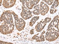 DDX58 / RIG-1 / RIG-I Antibody - Immunohistochemistry of paraffin-embedded Human esophagus cancer tissue  using DDX58 Polyclonal Antibody at dilution of 1:35(×200)