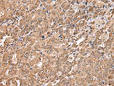 DDX58 / RIG-1 / RIG-I Antibody - Immunohistochemistry of paraffin-embedded Human ovarian cancer tissue  using DDX58 Polyclonal Antibody at dilution of 1:40(×200)
