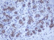 DDX59 Antibody - IHC of paraffin-embedded Human breast tissue using anti-DDX59 mouse monoclonal antibody.