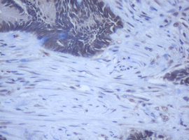 DDX59 Antibody - IHC of paraffin-embedded Adenocarcinoma of Human colon tissue using anti-DDX59 mouse monoclonal antibody.