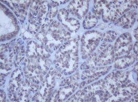 DDX59 Antibody - IHC of paraffin-embedded Carcinoma of Human thyroid tissue using anti-DDX59 mouse monoclonal antibody.