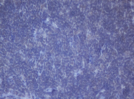 DDX59 Antibody - IHC of paraffin-embedded Human lymphoma tissue using anti-DDX59 mouse monoclonal antibody.