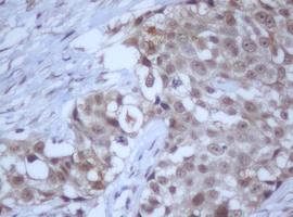 DDX59 Antibody - IHC of paraffin-embedded Adenocarcinoma of Human breast tissue using anti-DDX59 mouse monoclonal antibody.