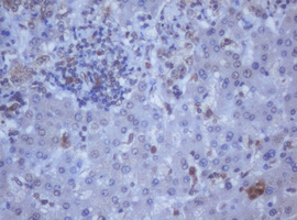 DDX59 Antibody - IHC of paraffin-embedded Carcinoma of Human liver tissue using anti-DDX59 mouse monoclonal antibody.