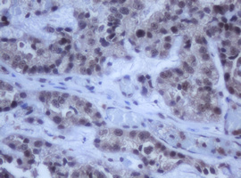 DDX59 Antibody - IHC of paraffin-embedded Adenocarcinoma of Human ovary tissue using anti-DDX59 mouse monoclonal antibody.
