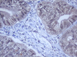 DDX59 Antibody - IHC of paraffin-embedded Adenocarcinoma of Human endometrium tissue using anti-DDX59 mouse monoclonal antibody.